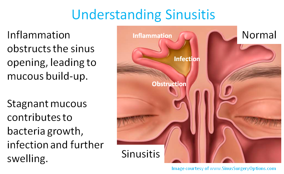 sinus rinse masses of mucus